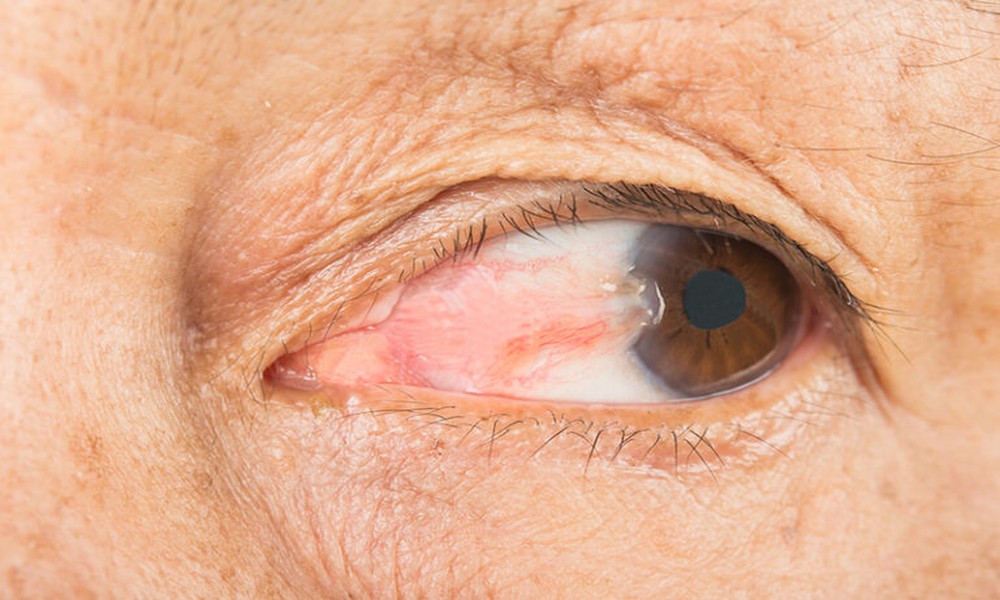 Signs You May Need Pterygium Treatment In Hawaii